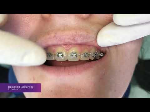 Orthodontic lacing