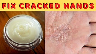 Natural home remedy for dry severely cracked hands and fingers – Fix chapped rough hands