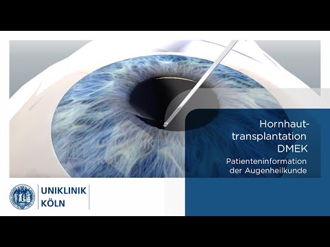 Hornhauttransplantation - DMEK