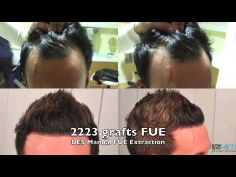 ASMED - Dr. Koray Erdogan - 1800 Grafts FUE #hairtransplant #hairtransplantturkey