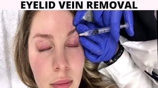 HOW TO GET RID OF EYELID VEINS // Electrosurgery