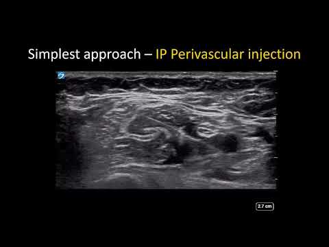 US-guided Axillary Brachial Plexus Block - the Simple Guide