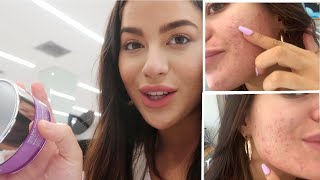 MY ACNE JOURNEY *cystic and textured skin*