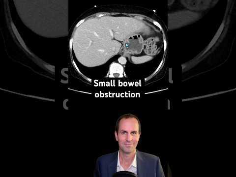 Abdominal CT Tutorials - Small bowel obstruction