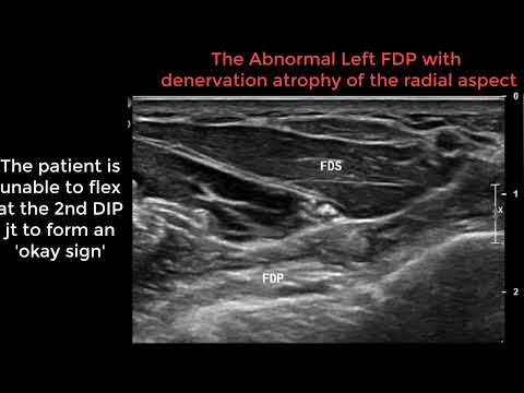 Median nerve / AIN injury in a 55M