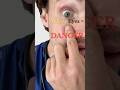 Cancer Worry: Yellow Eyes or Skin