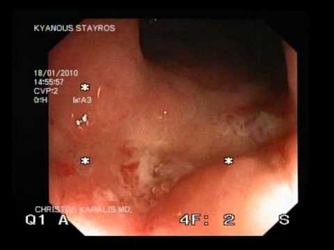 Solitary Ulcer In Rectum