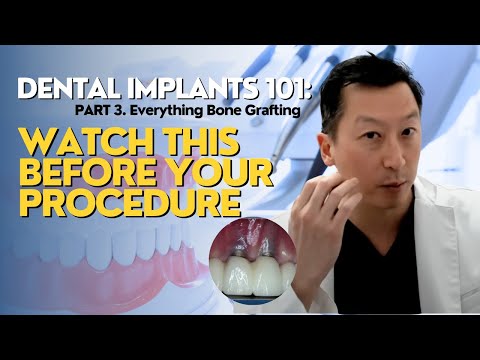 Dental Implants 101: What You NEED to Know! Part 3 (Everything Bone Grafting)