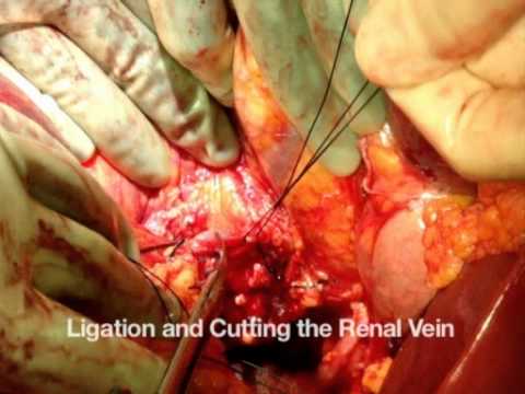 En-Block Mobilization Of The Pancreas And Spleen - Large Tumors Excision