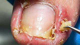 Surprising Ingrown Position! The Patient Was Treated For 2 Consecutive Days【Xue Yidao】