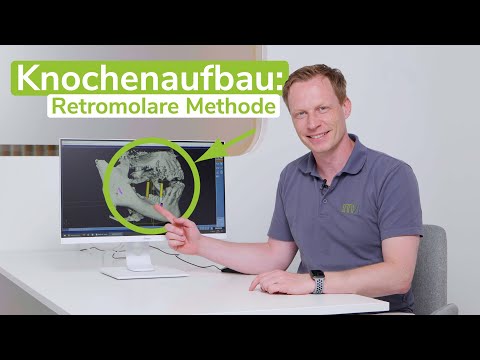 Retromolarer Knochenaufbau - Was ist das? | Dr. Frank-Ch. Langer - m71 Sankt Augustin