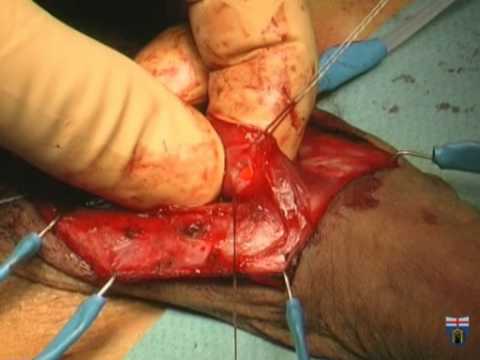 Anterior Urethral Reconstruction (Lingual Mucosal Graft) - Urethroplasty