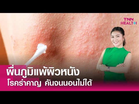 ผื่นภูมิแพ้ผิวหนัง โรครำคาญคันจนนอนไม่ได้ : TNN Health
