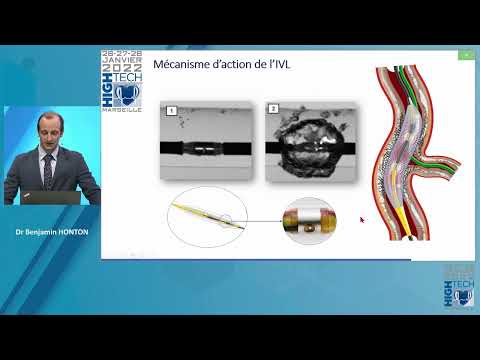 Une lésion idéale pour la Lithotripsie intra coronaire   Benjamin HONTON