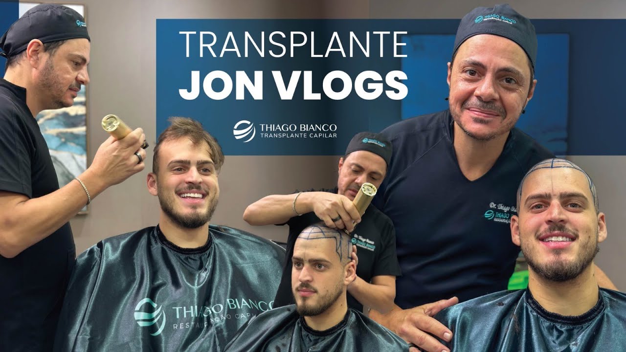 TRANSPLANTE CAPILAR DO JON VLOGS | MENOS UM CALVO | Dr. Thiago Bianco