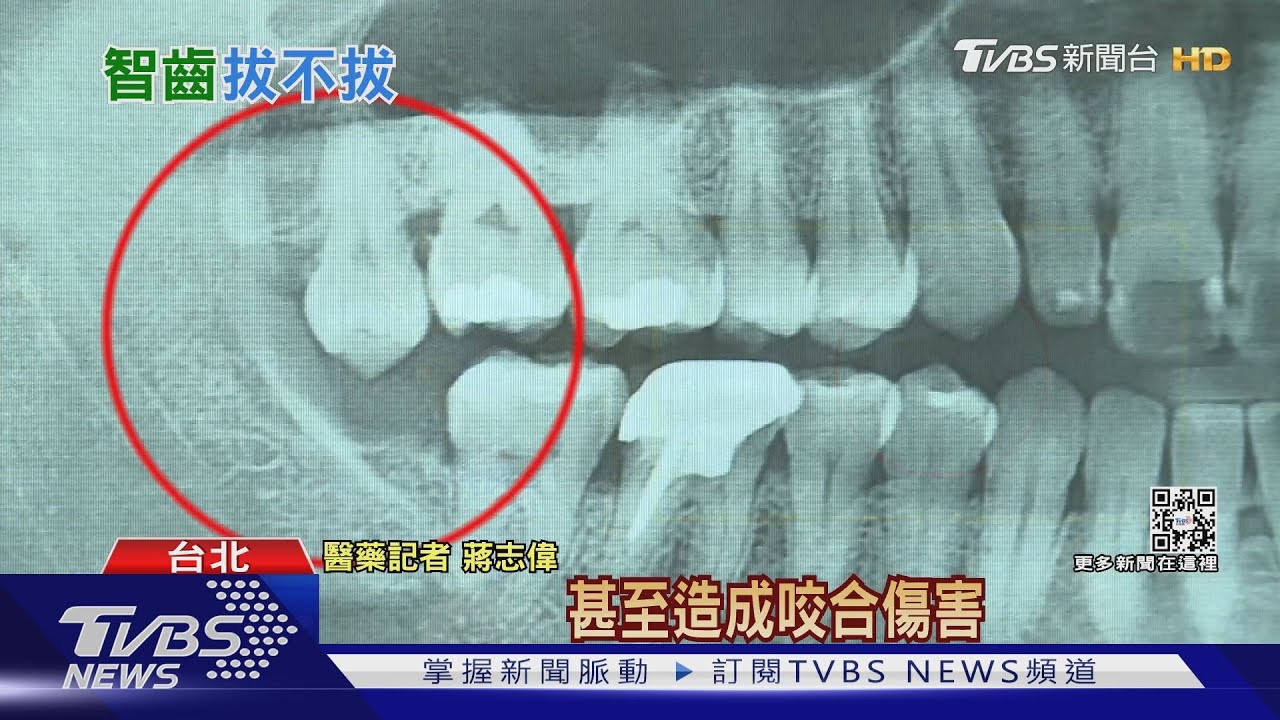 「不拔智齒」能和平共處嗎? 沒做好這件事恐罹口腔癌!