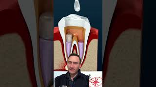 Así (NO) se hace una endodoncia. El enojo fue real Jaja.