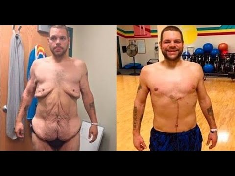 piel flacida abdomen por perdida de peso