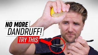 NO MORE Dandruff! 10 Hair Hacks to Fast Dandruff Removal!