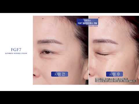 [더미코스] 강력한 FGF7크림의 사용 전 후