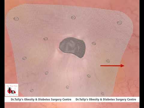 Umbilical Hernia Repair - Animation - Dr Tulip's TODS |  Animation of Repair  of Umbilical hernia