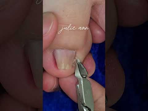 Ang dikit ng dryskin 