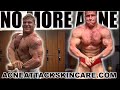 How To Get Rid Of Acne From Anabolic Steroids