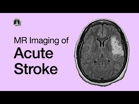 MR Imaging in Acute Stroke: Basics