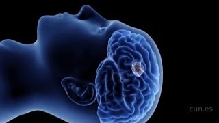 Ensayo con virus modificado contra el glioblastoma - Marta María Alonso Roldán