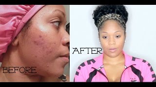 How To: Stop Acne Breakout Fast + Get Rid Of Pimples Overnight & Get Rid Of Acne Scars/Dark Spots