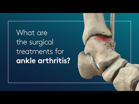 What are the surgical treatments for ankle arthritis?