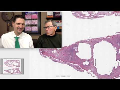 Pattern 2 – Fibrosis, UIP complicated by malignant mesothelioma (Top 25 Pearls Series, Bonus Case)