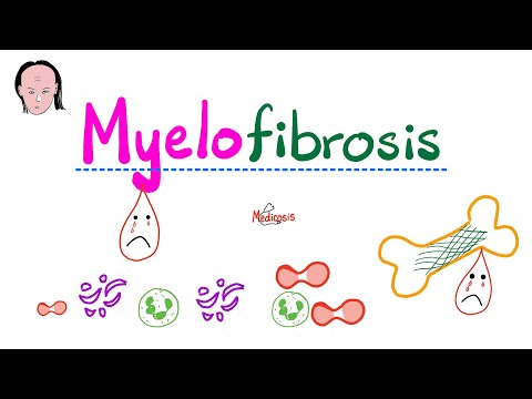 Primary Myelofibrosis (PMF) - Myeloproliferative Neoplasm - Bone Marrow Fibrosis