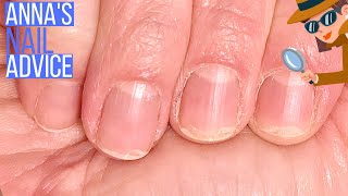 Peeling Nails Common Causes [ANNA