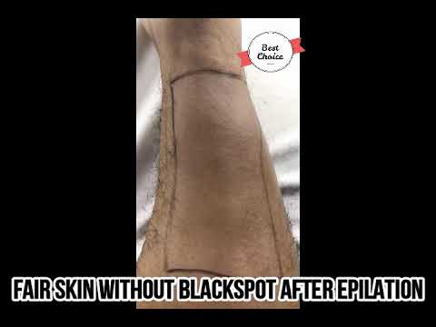 Shaving vs Epilator Hair Removal (With Megami 4in1 Epilator)