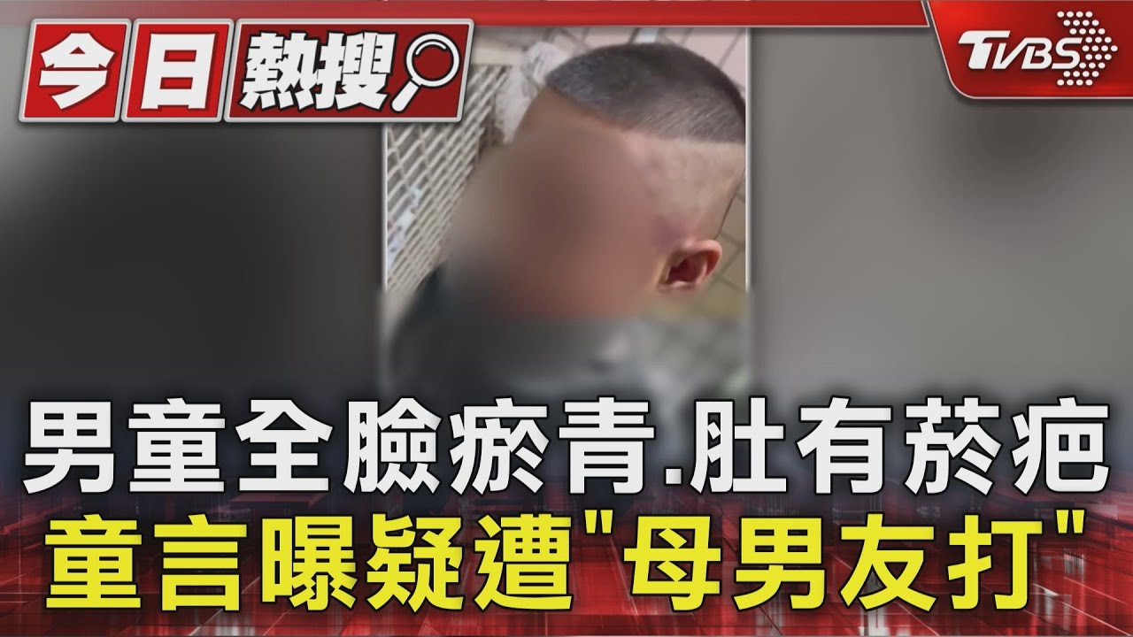 頭腫男童驗傷驚見菸疤!疑遭母男友毆打 母稱「小孩愛說謊」遭親友打臉