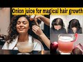Sirf 1 Pyaaz Aap Ke Baal Wapis La Sakta Hai Onion Juice For Hair Growth