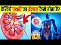देखिये 3D में Kidney Stone पथरी का ईलाज कैसे होत