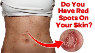 Do you have these red spots on your skin? | Natural treatment | Health and Beauty