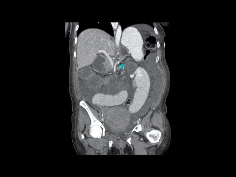 Computed Tomography Imaging Findings for Internal Hernia
