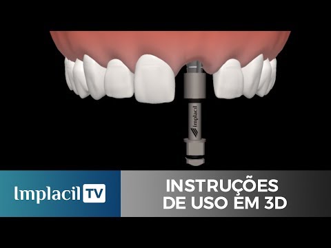download lagu mp3 mp4 Cone Morse Implants, download lagu Cone Morse Implants gratis, unduh video klip Cone Morse Implants