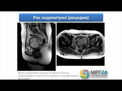Видео лечение спины Остеохондроз шейный и его последствия