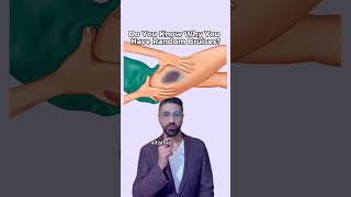 Do you know why you get random bruises?