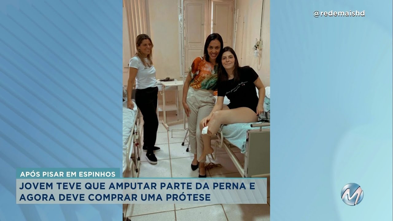 Impressionante: mineira de Ubá amputa a perna após pisar em espinho