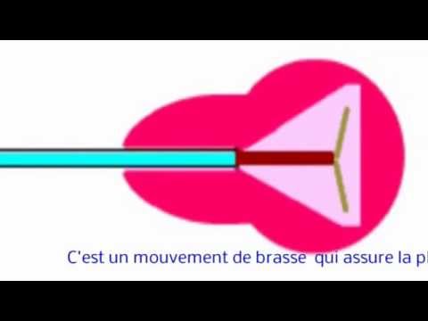 comment poser implanon