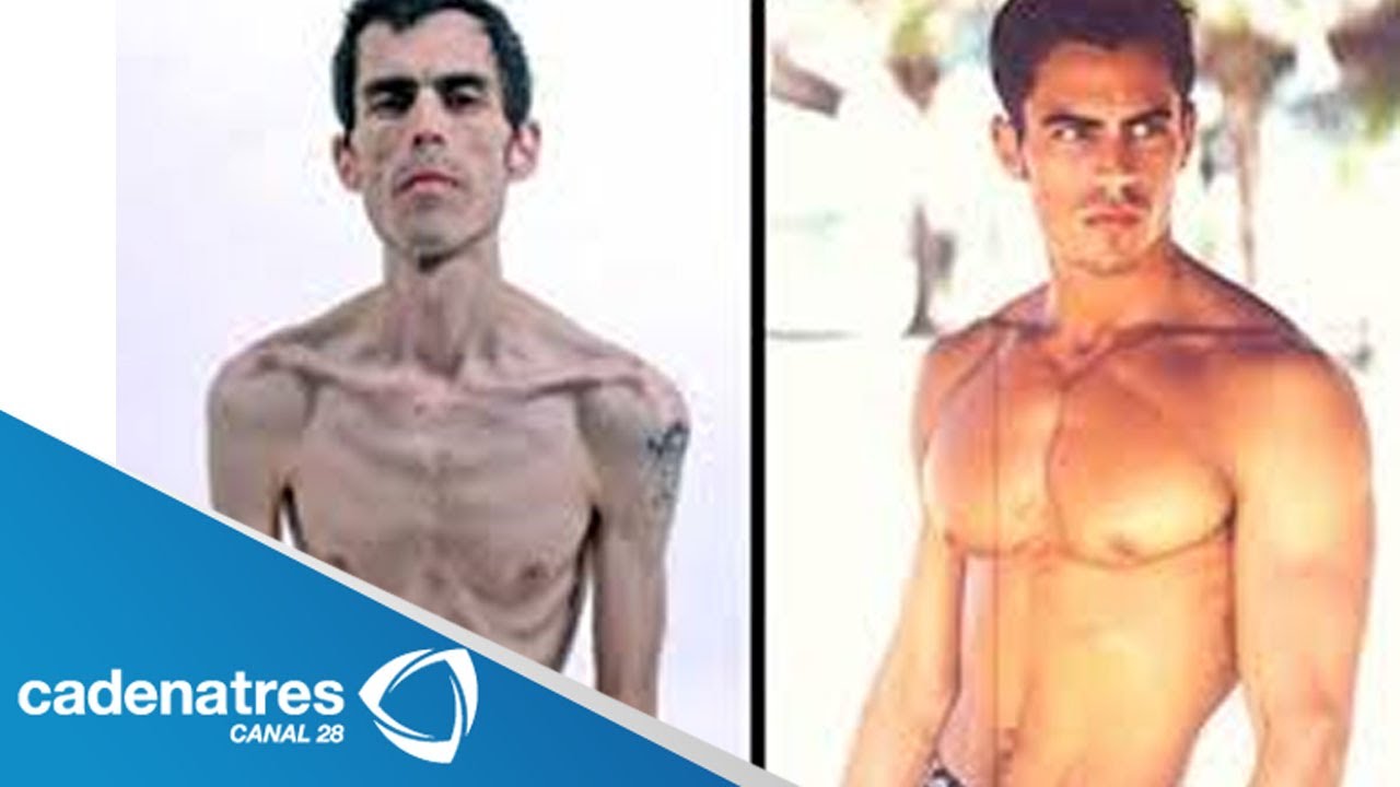 Bulimia y Anorexia, un mal que afecta a hombres y mujeres