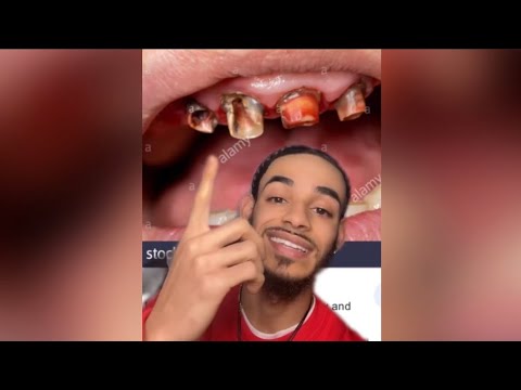 Fluoride Toothpaste Is A SCAM?!