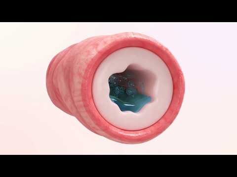 Adolescent Resources: Cystic Fibrosis Animation - Hypertonic Saline video modal