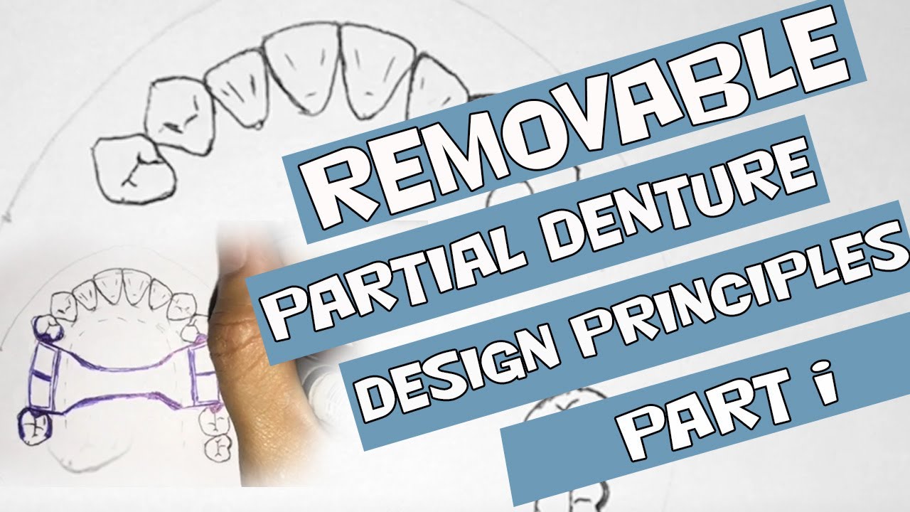 Removable Partial Denture Design Principles (Part I)