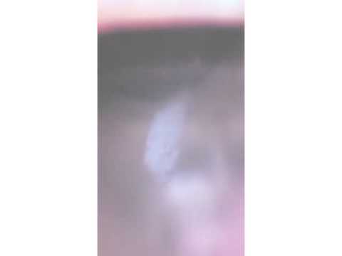 RetCam Imaging of Case 1